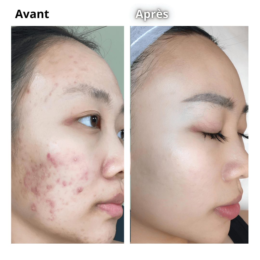 LUMISTICK - The secret to radiant and firm skin in 5 minutes